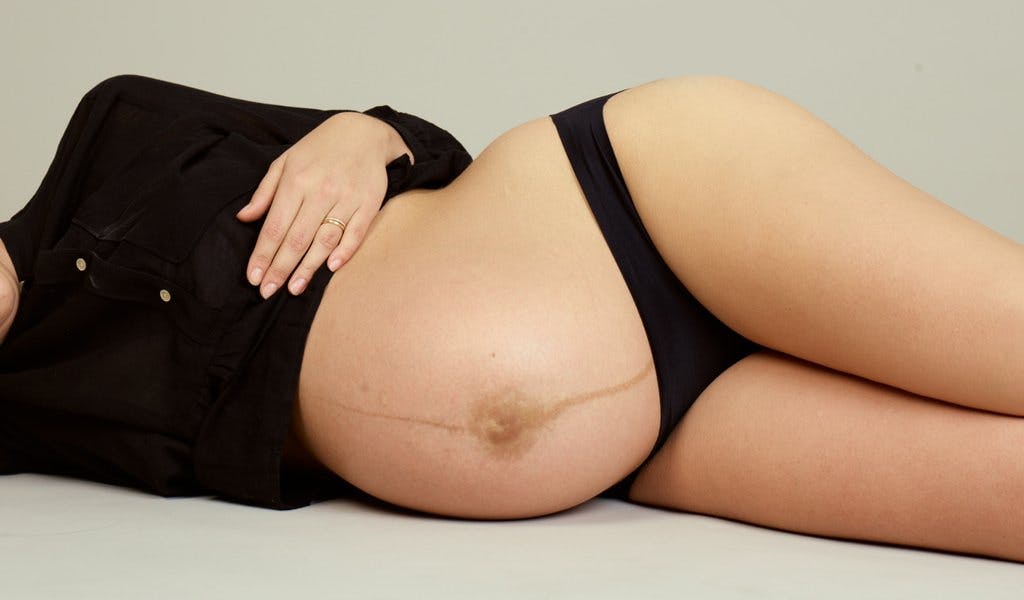 Diastasis Recti: Why It's Not As Scary As It Sounds Photo